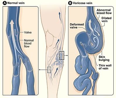 Levicose repairs blood vessel walls