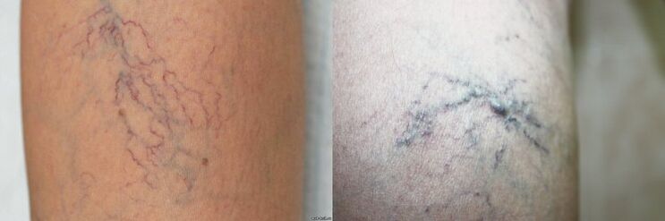 Symptoms of varicose veins