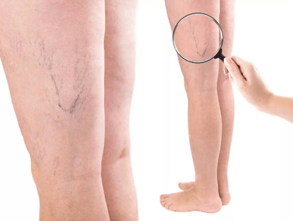 Varicocele veins in women