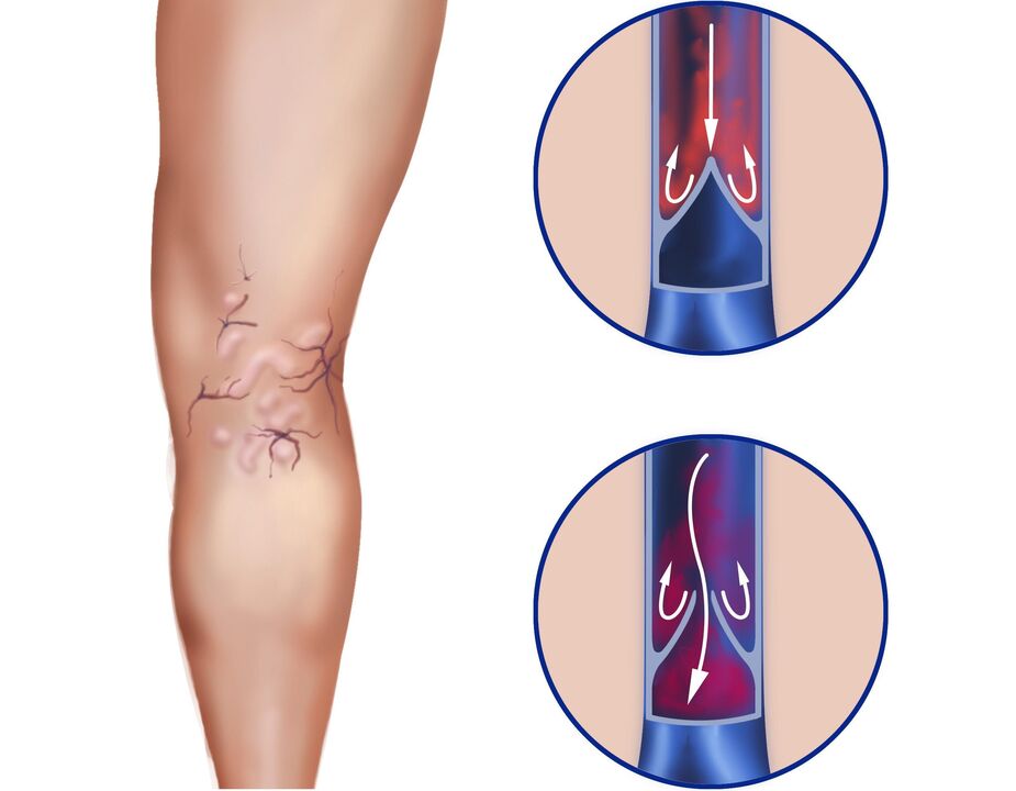 What happens to the veins of varicose veins