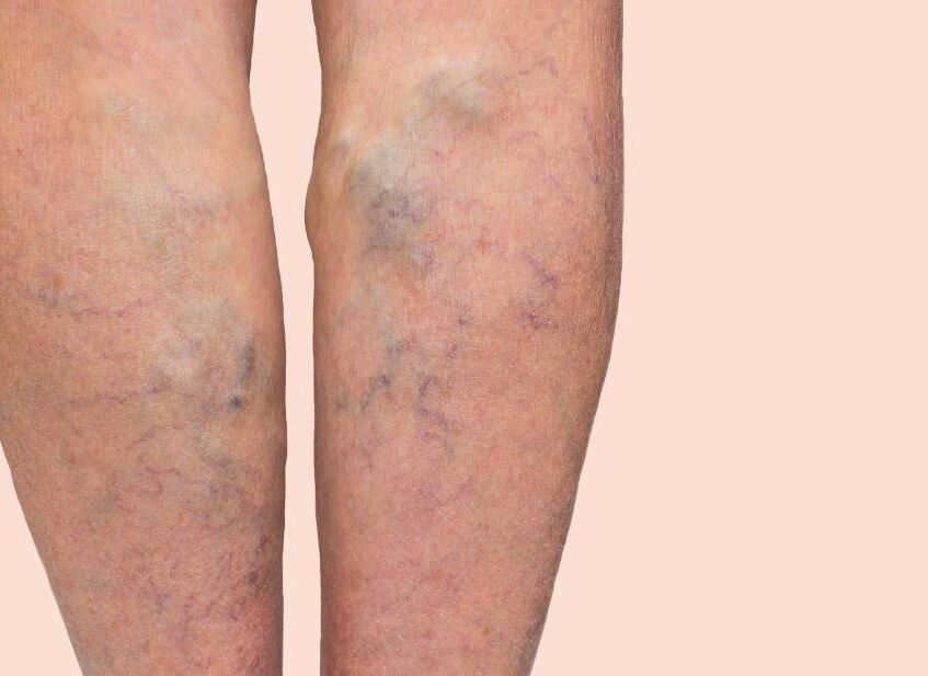 What is varicose veins like