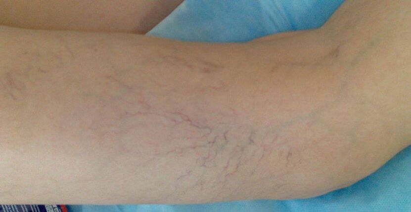 Blood vessels on the legs