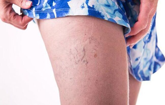 Varicose veins on the legs