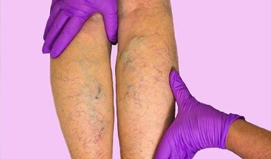 What can varicose veins be done and what can’t be done