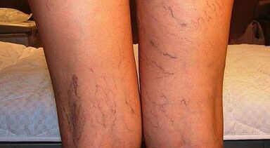How to treat varicose veins dilated in women