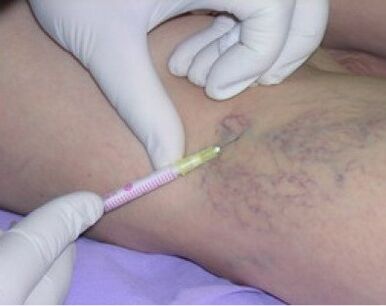 Injections to treat varicose veins