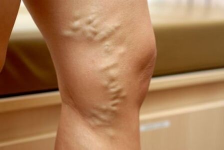 Medications to Treat Varicose Veins