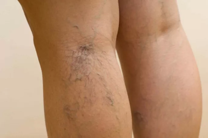 Leg vein pathology