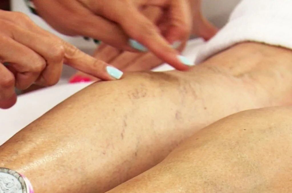 Check legs with varicose veins