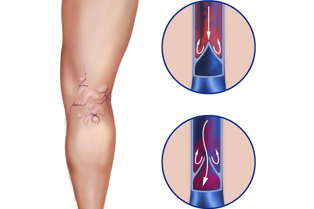 Varicose veins in the legs