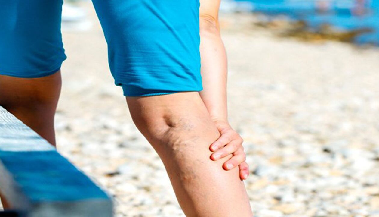 varicose vein pain in the legs