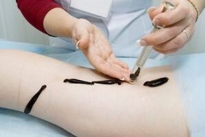 The use of leeches in the treatment of varicose veins