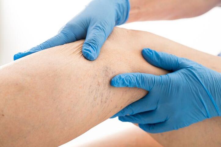 Doctor examining leg with varicose veins