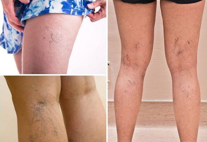 Varicose veins in the legs