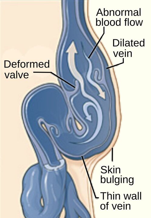 Varicose veins