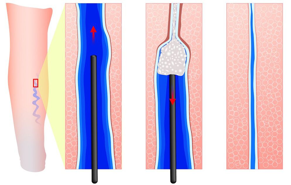 Mechanism of Sclerotherapy