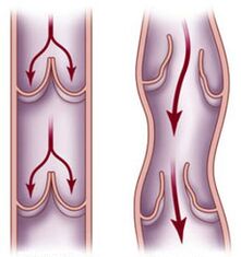 Impaired blood flow in healthy veins and varicose veins