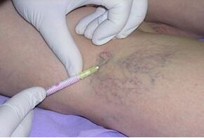 Sclerotherapy is a treatment for varicose veins in the legs