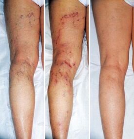 Treatment effect of varicose veins of lower limbs