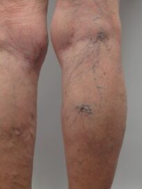 Varicose veins of the lower limbs, tortuous veins protruding from the surface of the skin