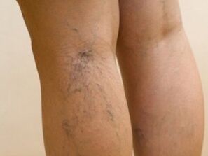 Veins protruding from under the skin are symptoms of varicose veins in the legs