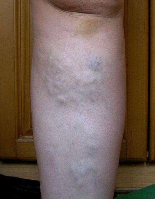 Swelling of leg veins due to varicose veins