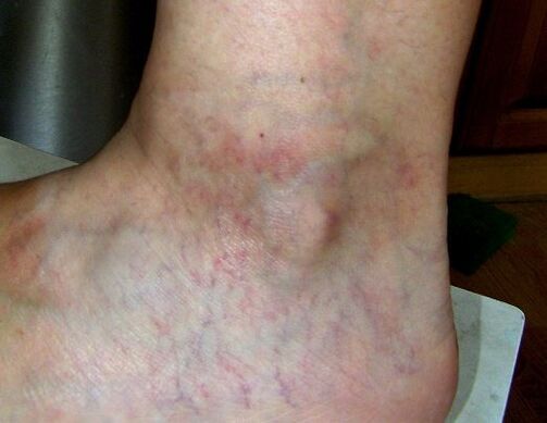 Symptoms of varicose veins in lower limbs